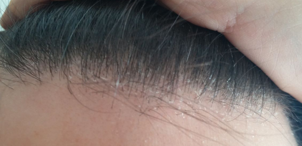 dermatite seborroica capelli