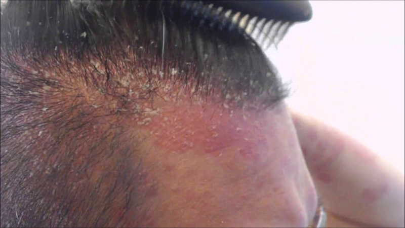 dermatite seborroica capelli
