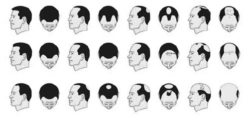 Tipi di Alopecia