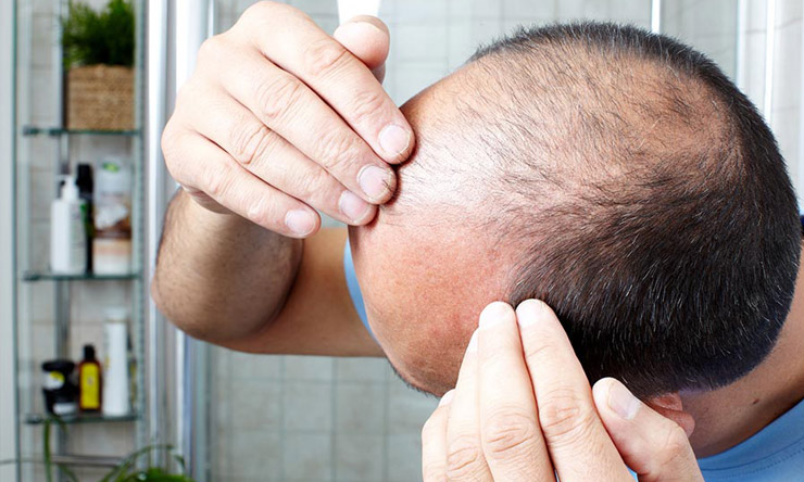 alopecia femminile maschile